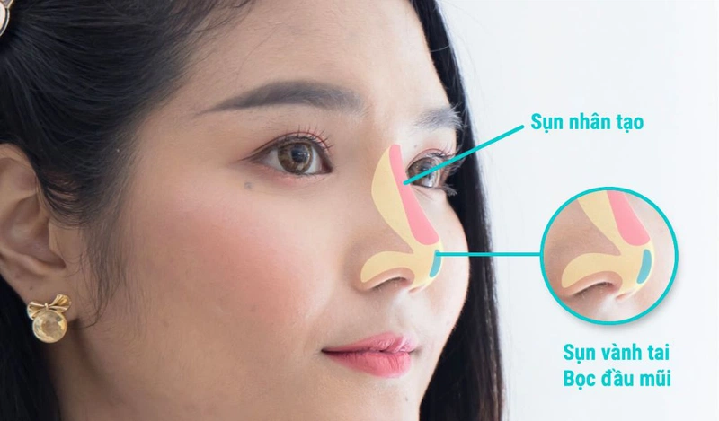 Bác sĩ giải đáp: Nâng mũi bọc sụn chỉ phù hợp với ai?