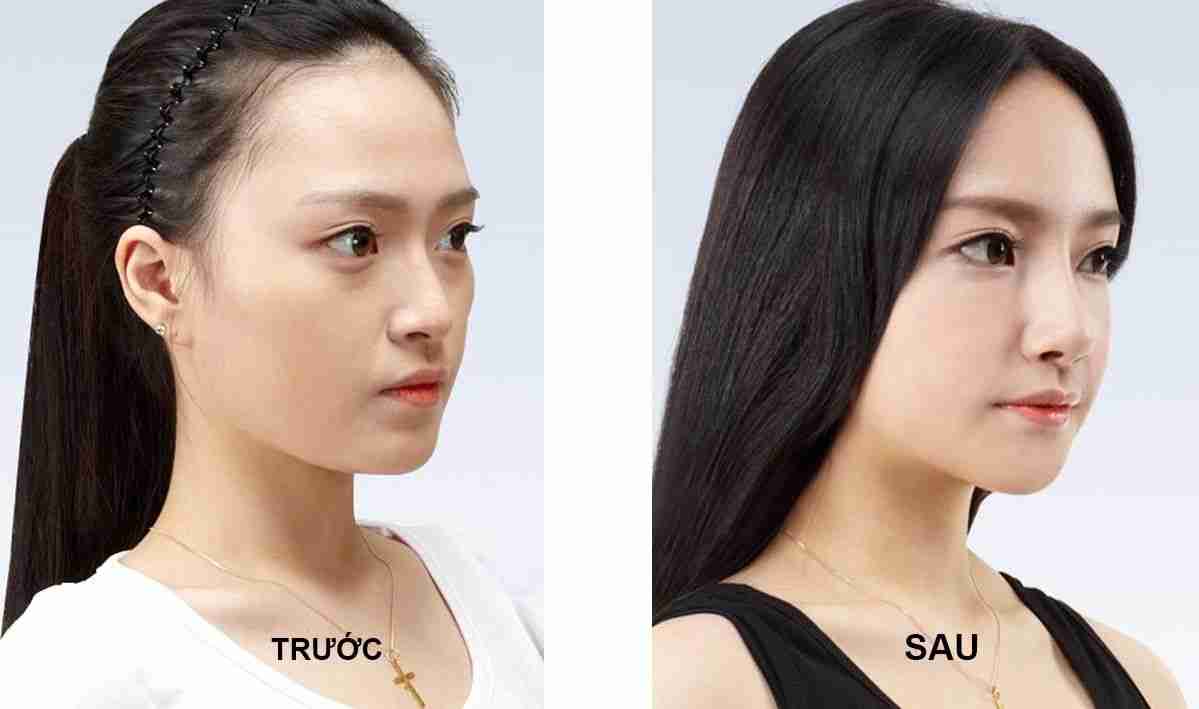 Bác sĩ giải đáp: Nâng mũi bọc sụn chỉ phù hợp với ai?