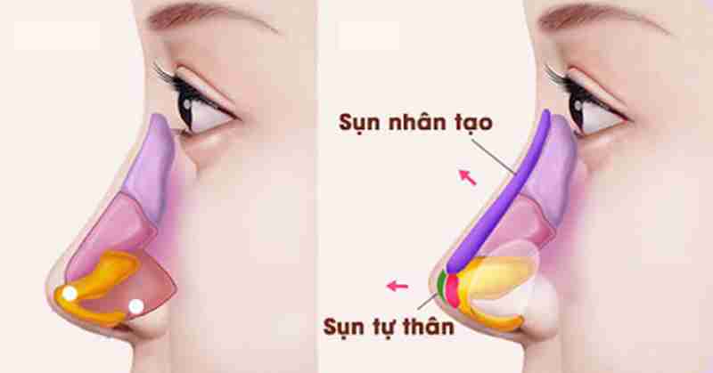 Nâng mũi cấu trúc, liệu có phải là trào lưu nhất thời?
