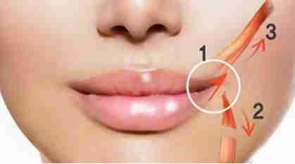 Phẫu thuật môi cười có để được vĩnh viễn không?