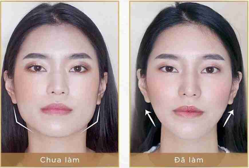 Tất tần tật về tiêm trẻ hoá tạo hình khuôn mặt
