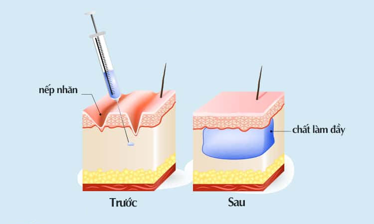 Góc thắc mắc:Tiêm HA trẻ hóa giá bao nhiêu?