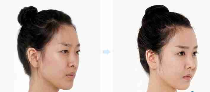Cấy mỡ má hóp có làm thay đổi gương mặt không?