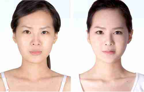 Cấy mỡ má hóp có làm thay đổi gương mặt không?