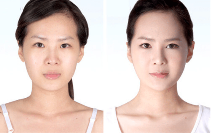 Chia sẻ kinh nghiệm cấy mỡ mặt Babyface trẻ hóa da