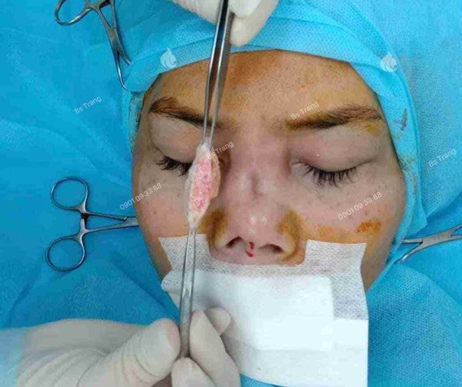 chi phí nâng mũi trung bì mỡ tại tphcm giá bao nhiêu