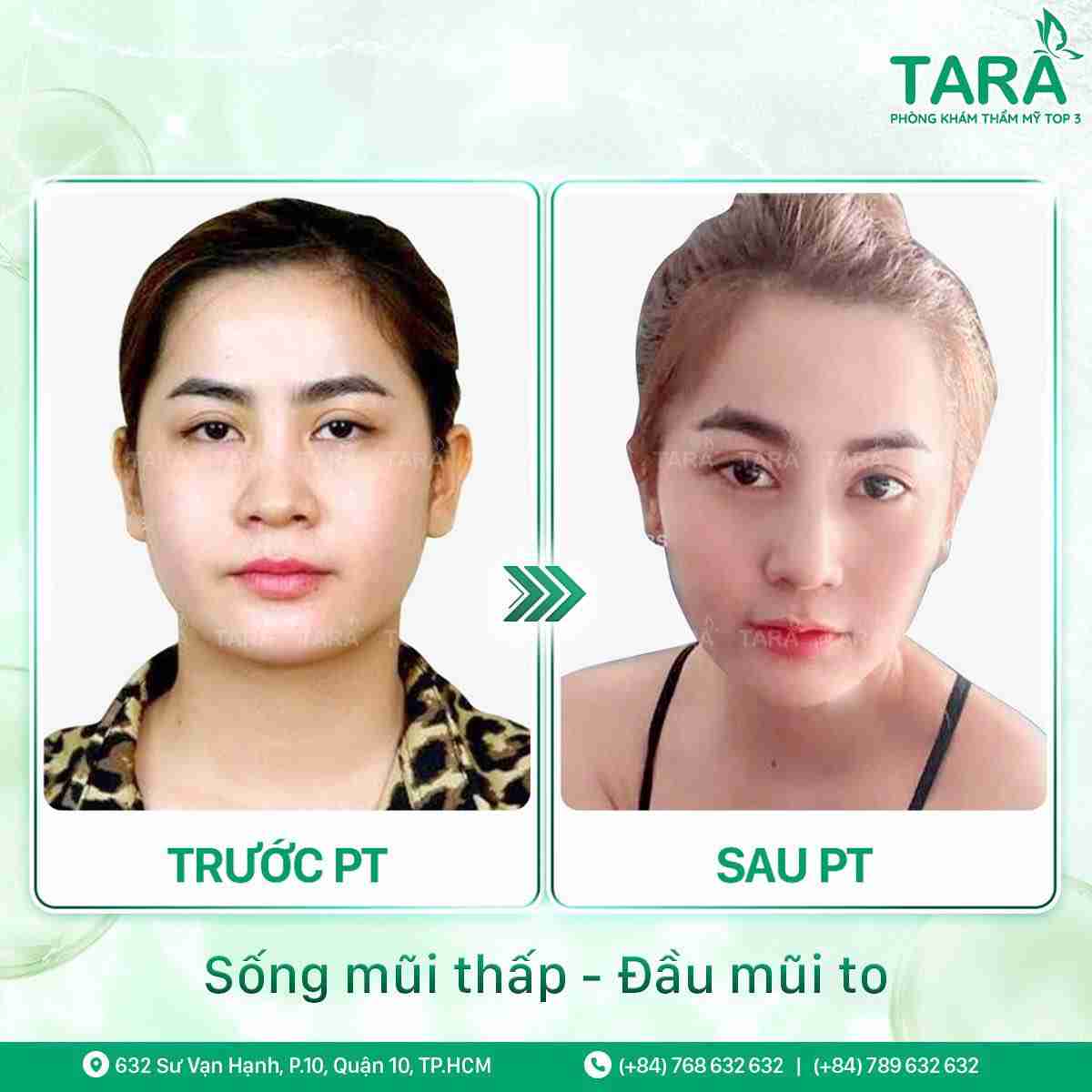 Tại TPHCM, nâng mũi cấu trúc ở đâu tốt và giá cả hợp lý?