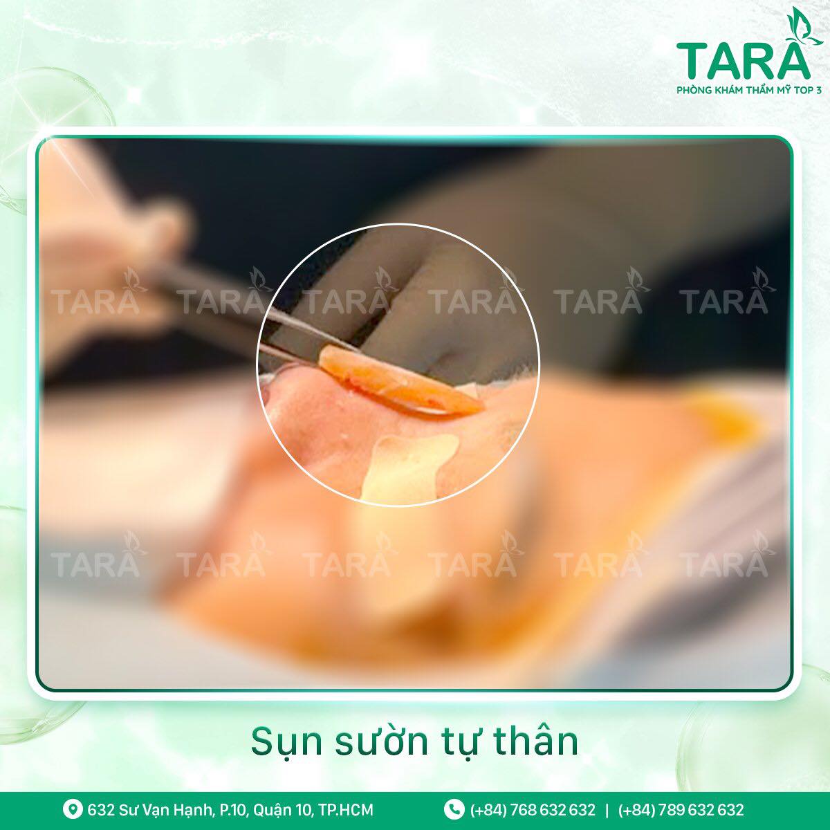 Nâng mũi sụn sườn có bền không?