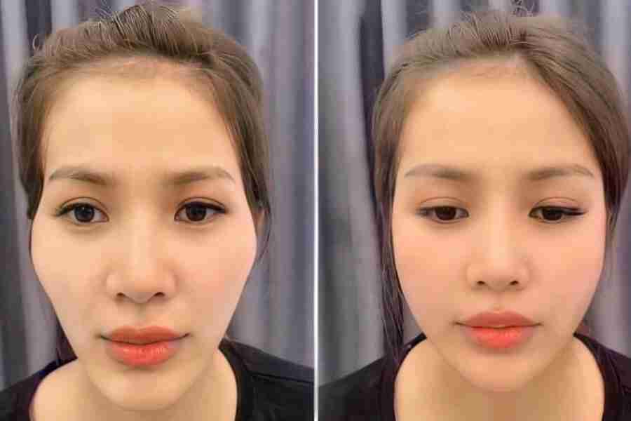 Tiêm cân chỉnh khuôn mặt bằng filler có tốt không?