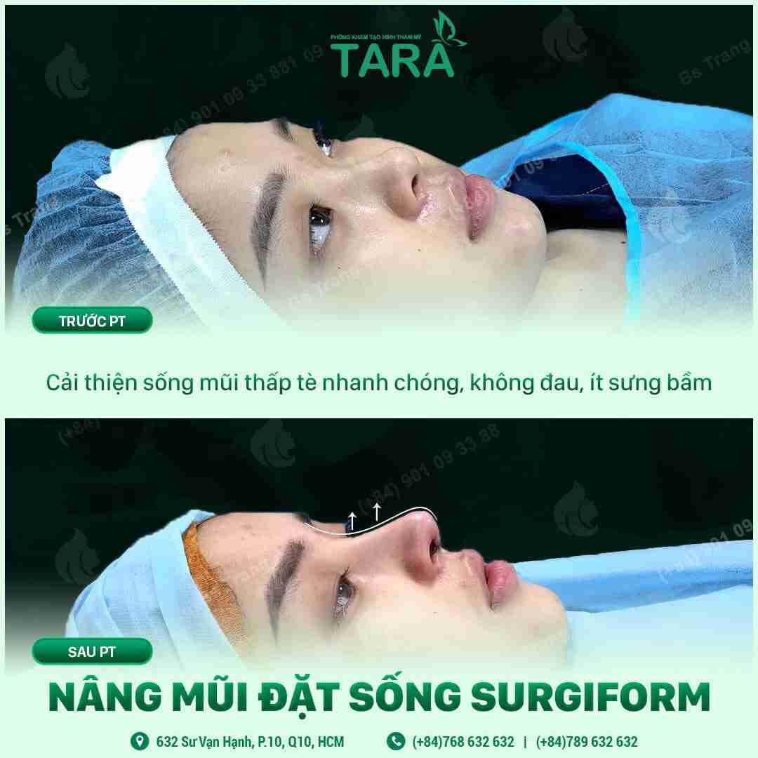 Ưu nhược điểm của nâng mũi sống surgiform