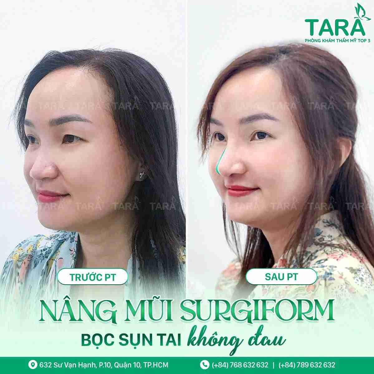 Ưu nhược điểm của nâng mũi sống surgiform