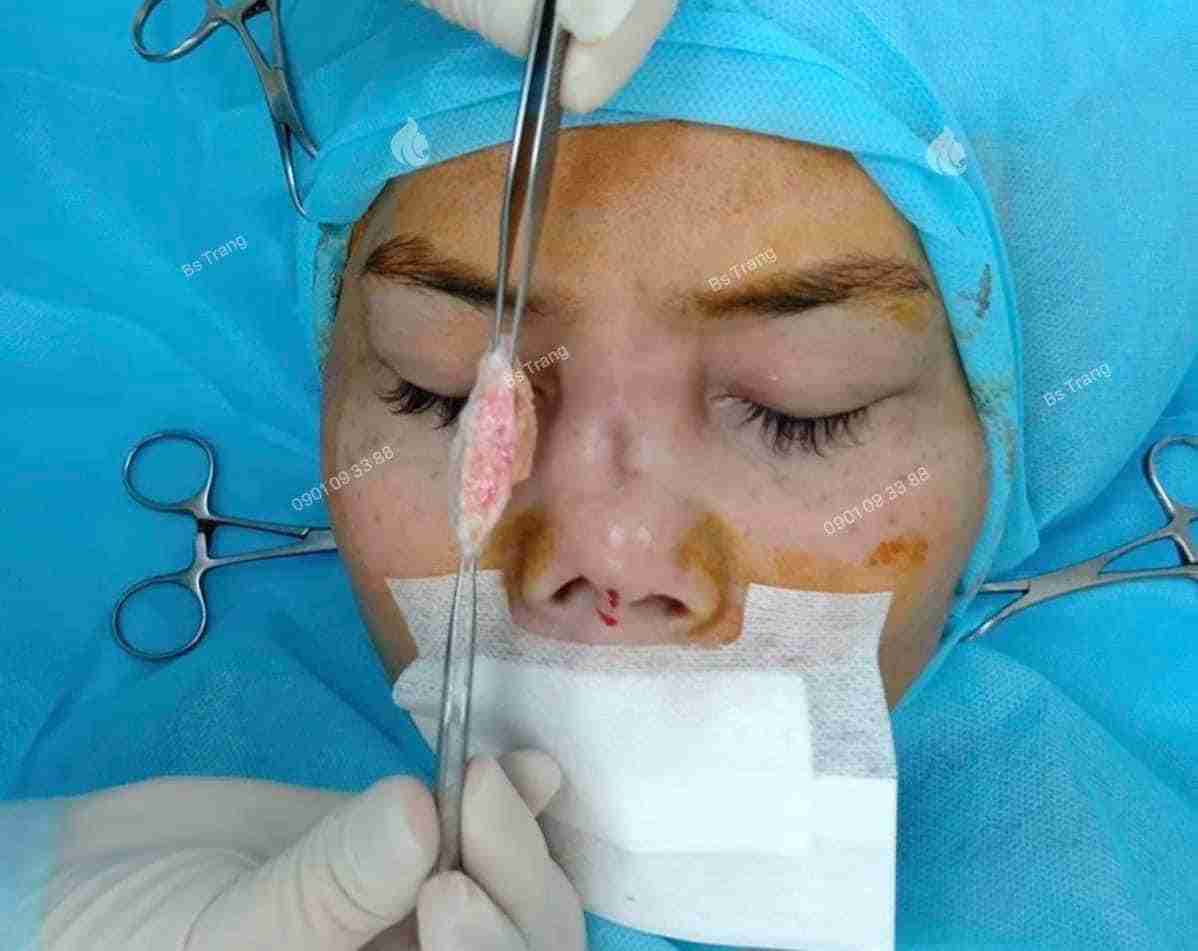Mỡ trung bì là gì? Tại sao được dùng để nâng mũi?