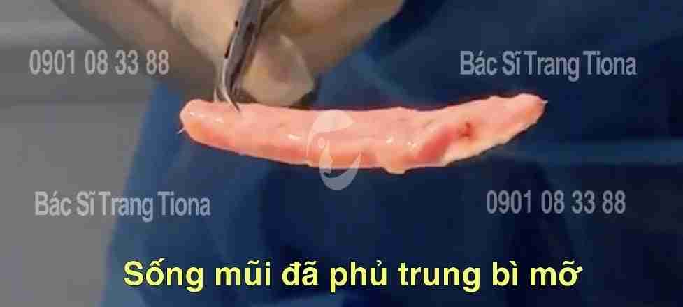 Mỡ trung bì là gì? Tại sao được dùng để nâng mũi?