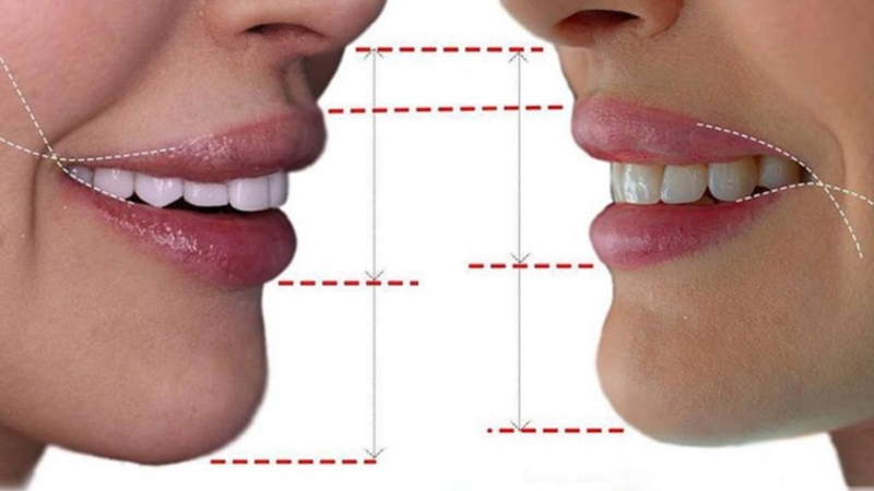 Phẫu thuật môi cười tự nhiên, không đau