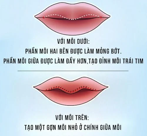 Sự thật phẫu thuật môi trái tim không đau