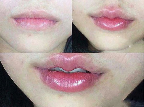 Sự thật phẫu thuật môi trái tim không đau