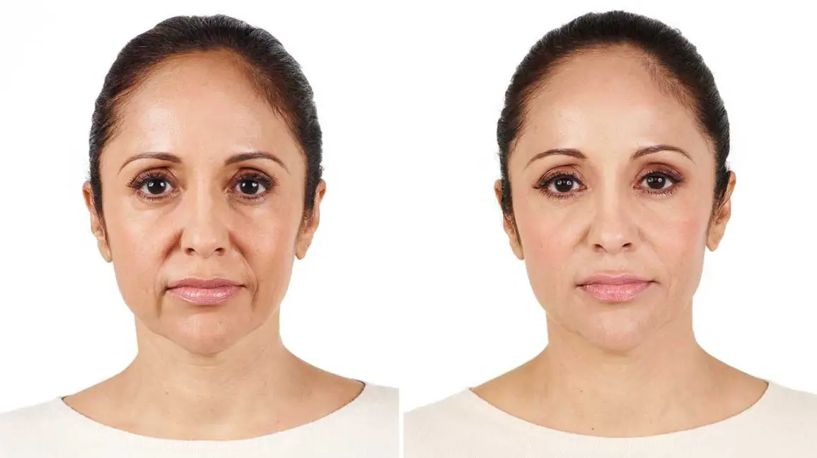 Tiêm cân chỉnh khuôn mặt bằng filler để được bao lâu?
