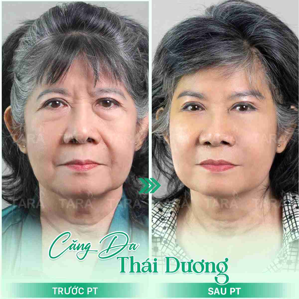 Bác sĩ giải đáp: Căng da mặt bán phần là gì?