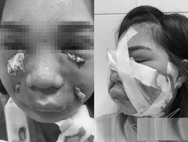 Cấy mỡ mặt babyface trẻ hoá và hệ luỵ từ biến chứng