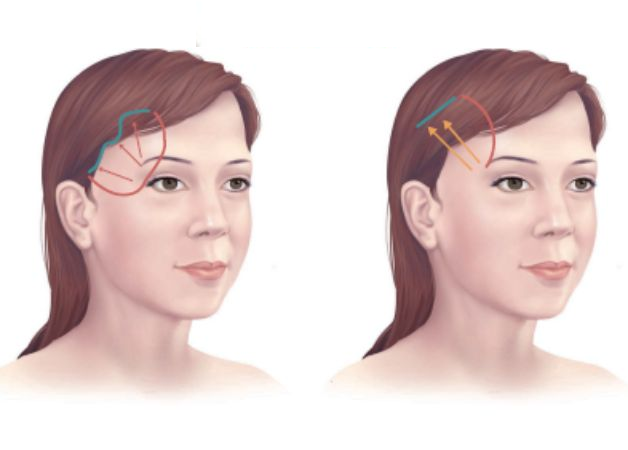 Biến chứng sau phẫu thuật căng da thái dương