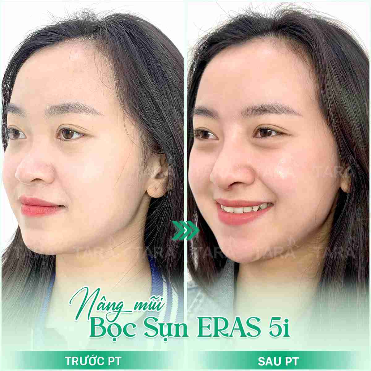 Hướng dẫn vệ sinh sau nâng mũi bọc sụn