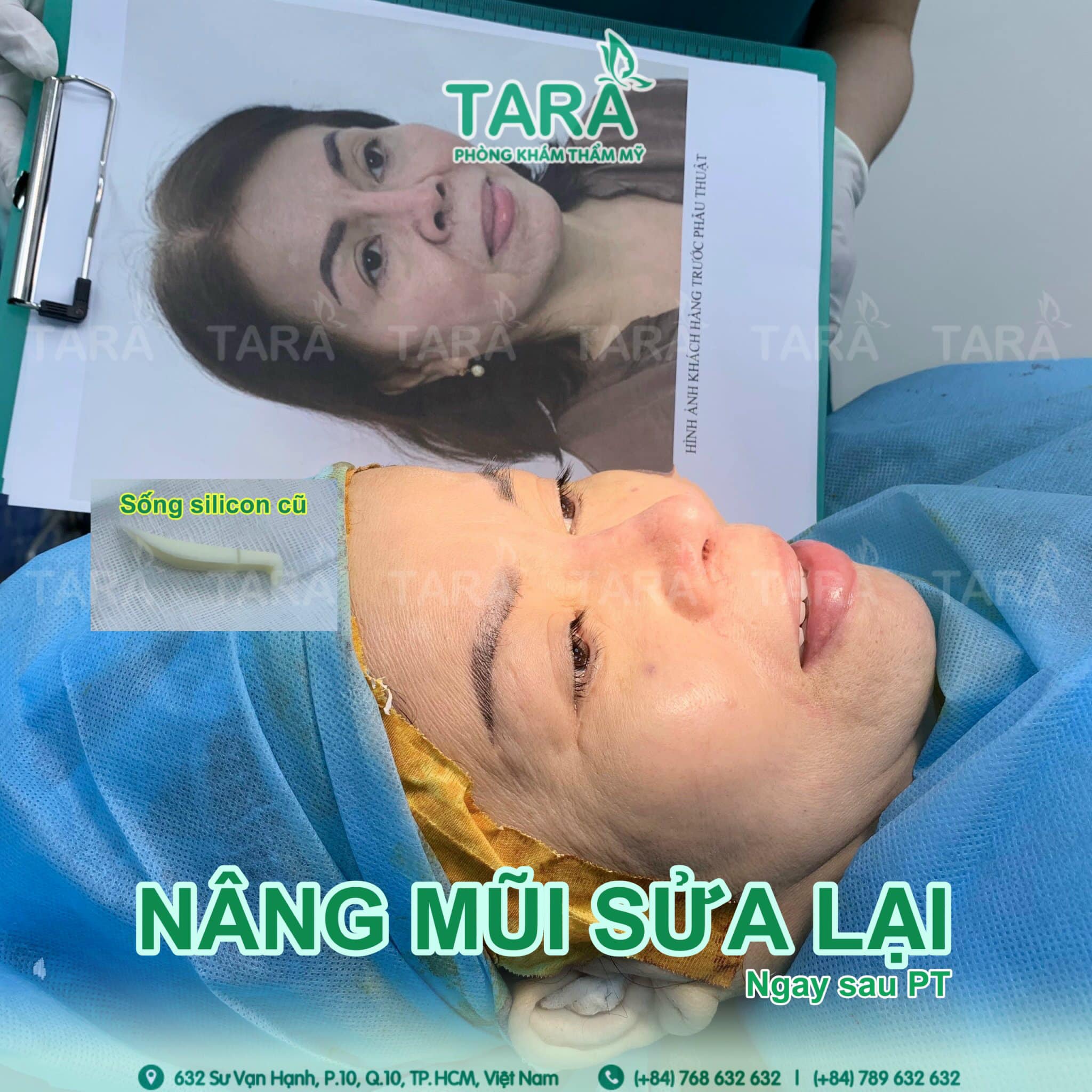 Bạn đã hiểu rõ về nâng mũi cấu trúc chưa?