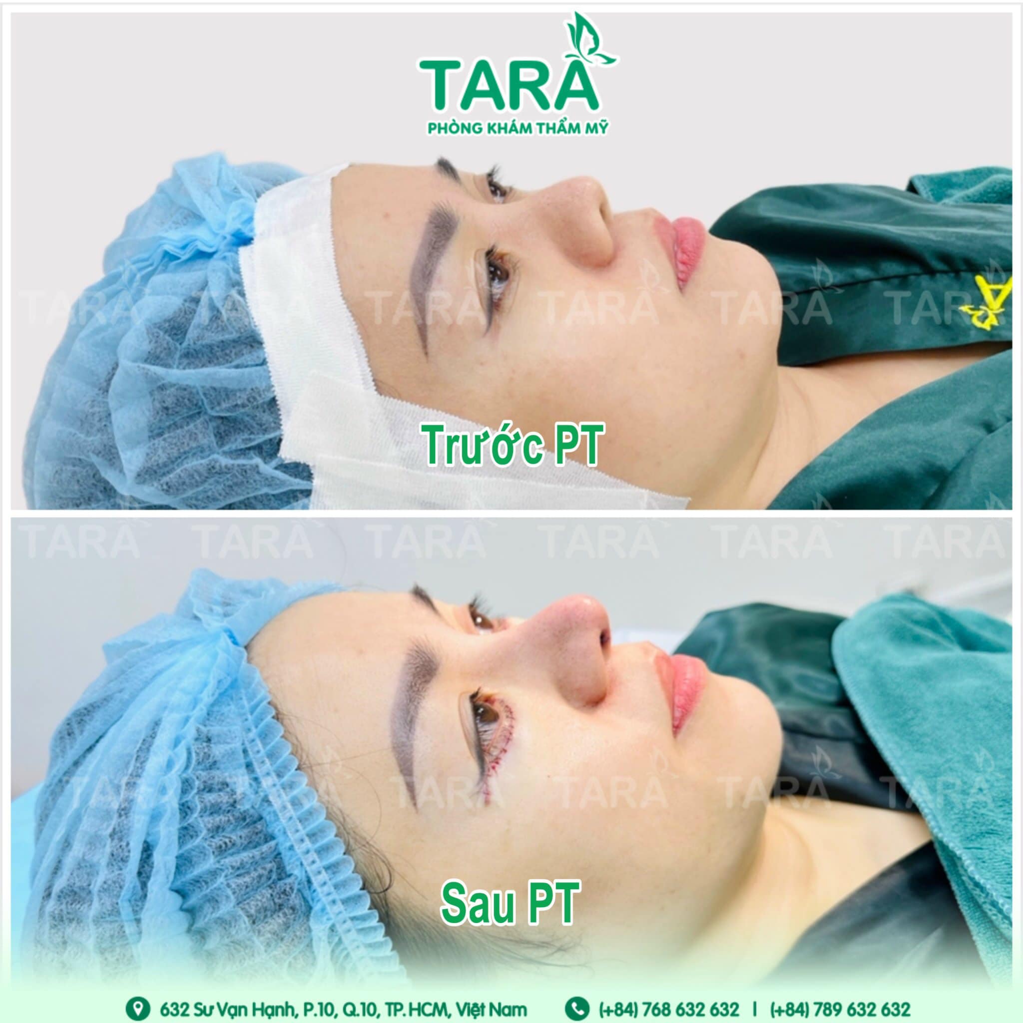 Tổng quan về phương pháp hiện đại nâng mũi siêu vi phẫu