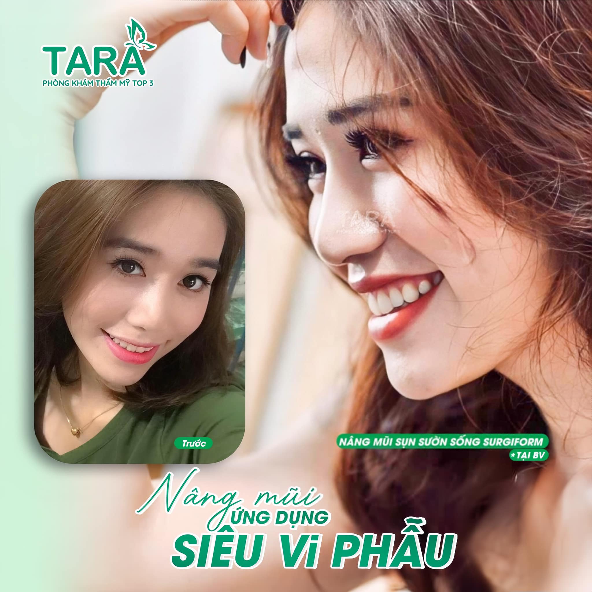 Quy trình nâng mũi sống Surgiform chuẩn Y khoa