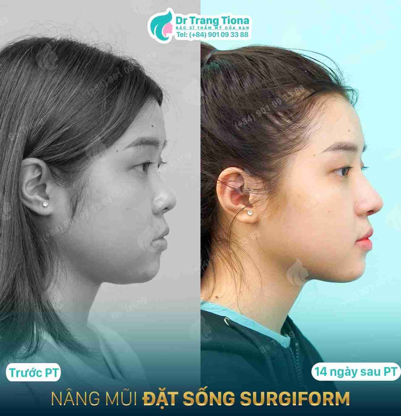Nâng mũi sống Surgiform có tốt không, tại sao?