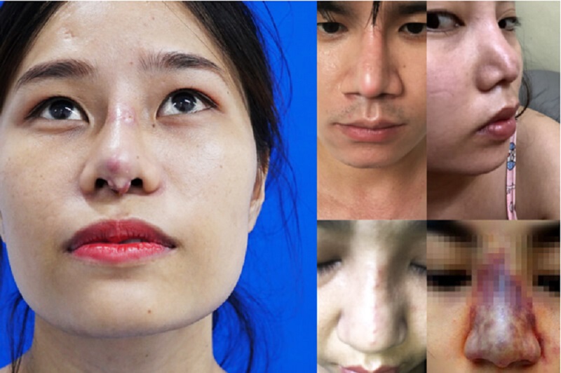 Những điều cần phải biết trước khi sửa mũi hỏng
