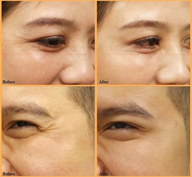Tiêm botox xoá nhăn có nên không?