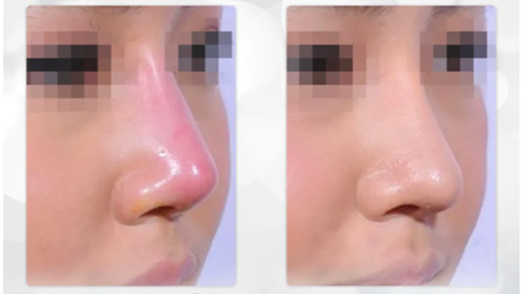 Da mũi mỏng có nâng mũi cấu trúc được không?