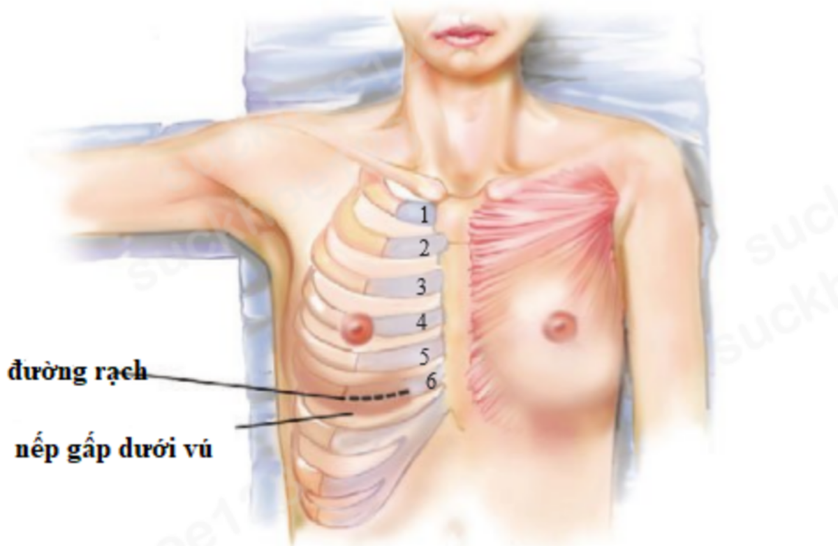 Nâng mũi sụn sườn thực hiện như thế nào?