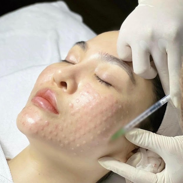 Gải đáp tổng hợp về tiêm căng bóng trẻ hoá da