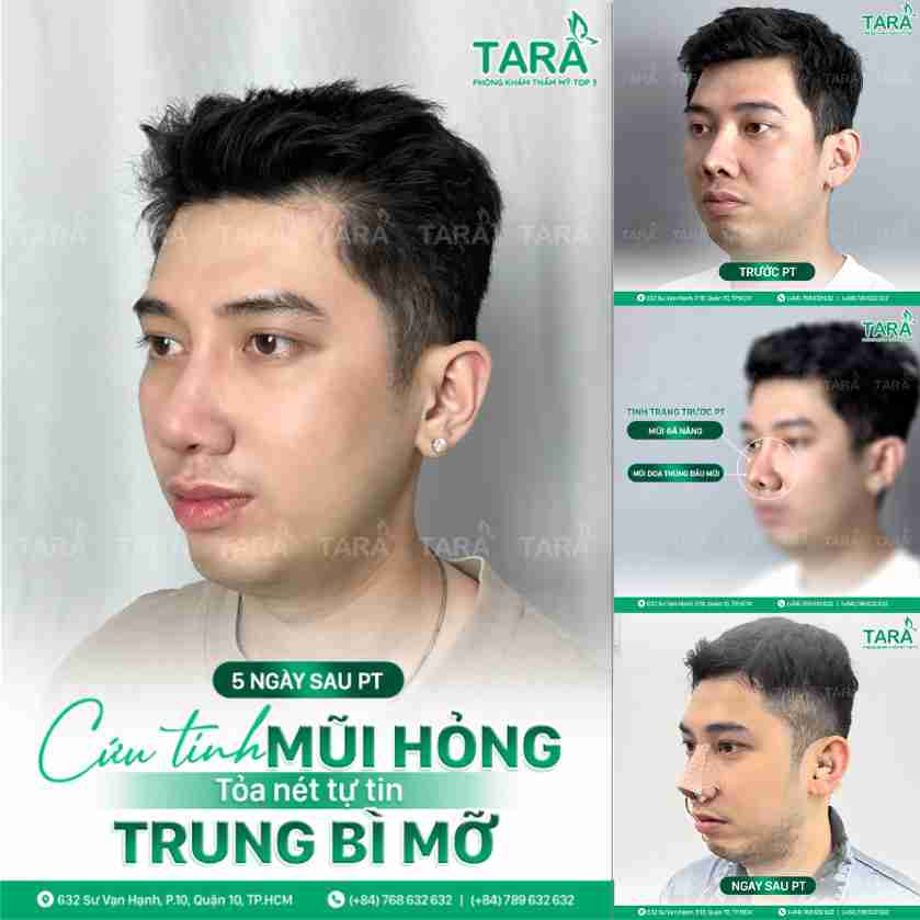 Lấy trung bì mỡ của người khác nâng mũi được không?