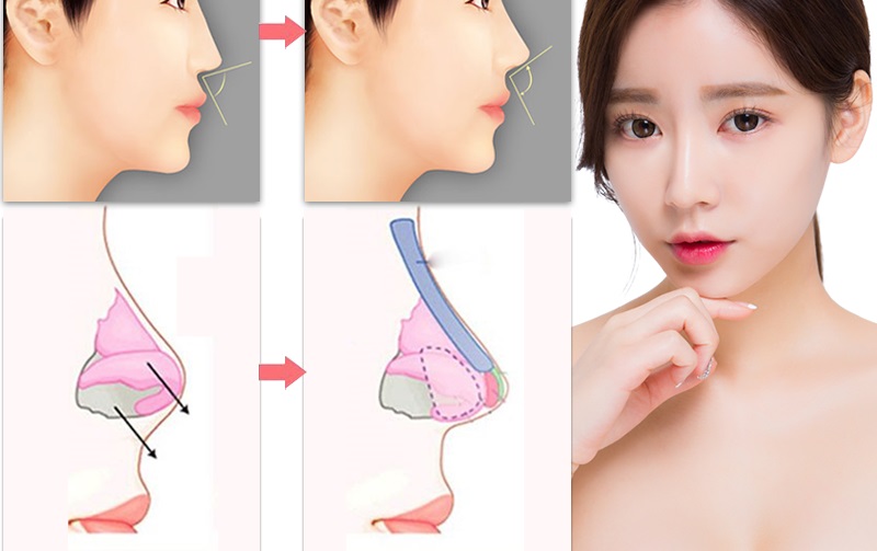 Căng da Midface xong có nâng mũi ngay được không?