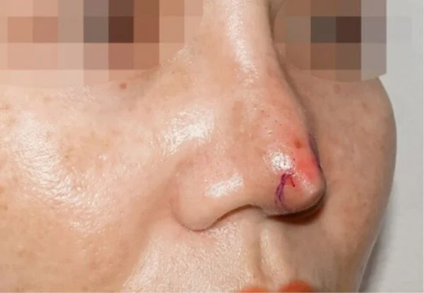 Nhận biết tình trạng tụt sụn mũi sau nâng và giải pháp 