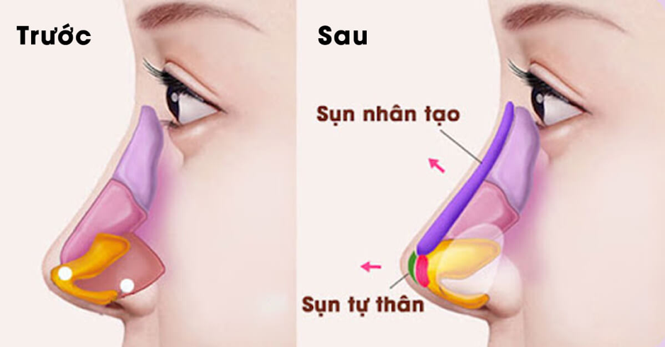 Tiêm trẻ hoá và nâng mũi cùng lúc được không?