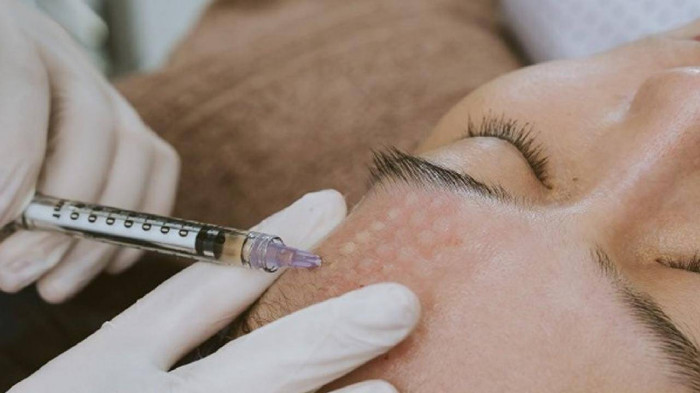 Tiêm căng bóng trẻ hoá da có nguy hiểm không?