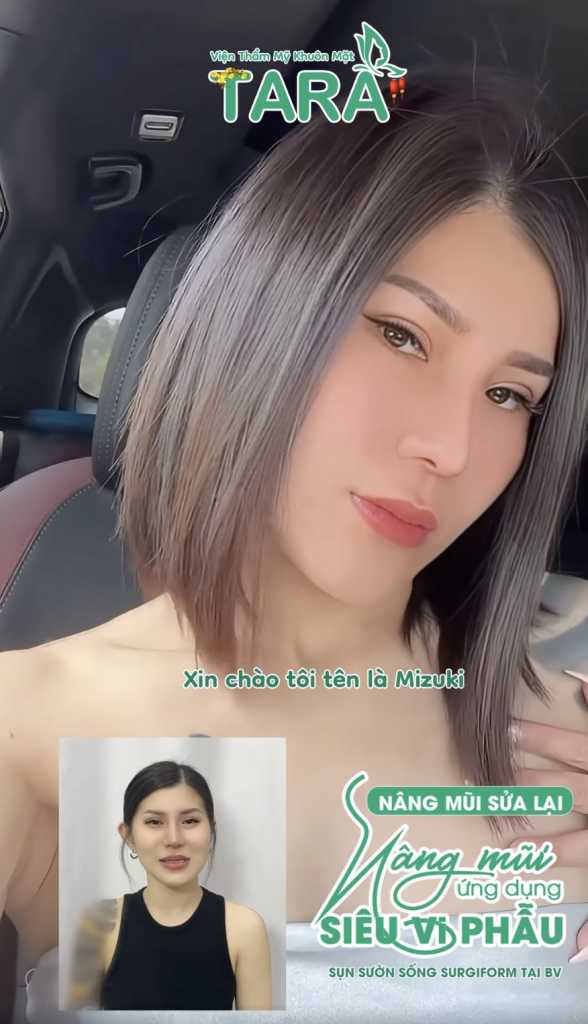 nâng mũi siêu vi phẫu không đau