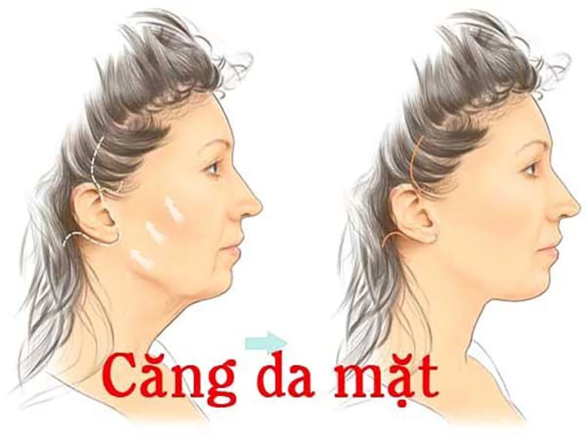 Căng da mặt toàn phần có nguy hiểm về sau không?