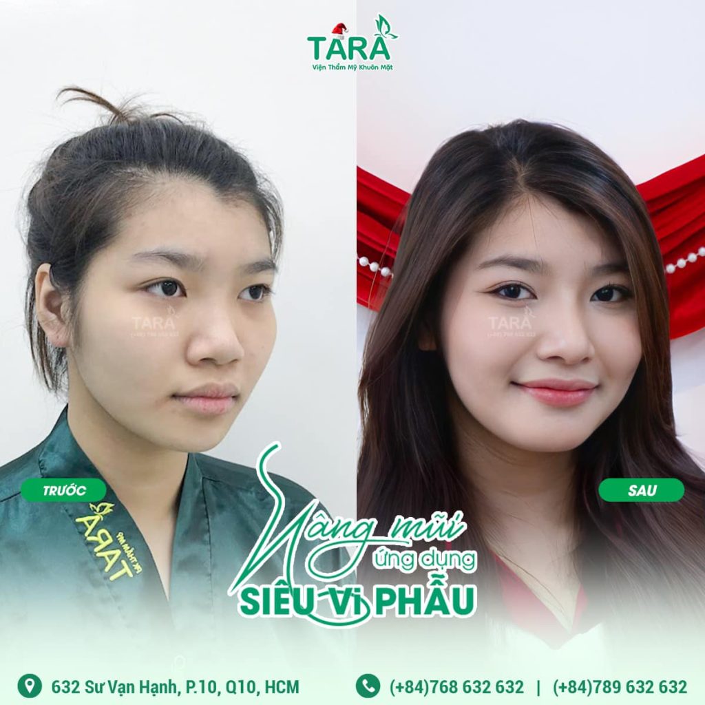 Địa chỉ nâng mũi không đau uy tín tại Quận 10, TP.HCM