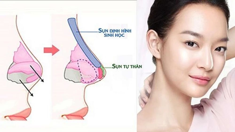 Địa chỉ nâng mũi không đau uy tín tại Quận 10, TP.HCM
