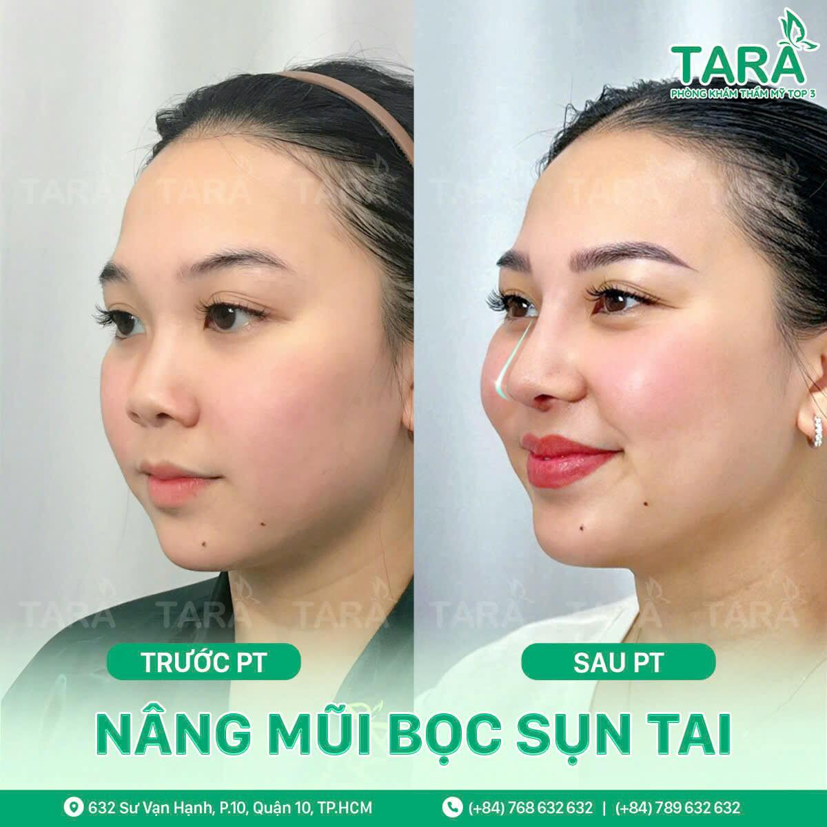Nâng mũi không đau: Sự thật hay chỉ là lời quảng cáo?