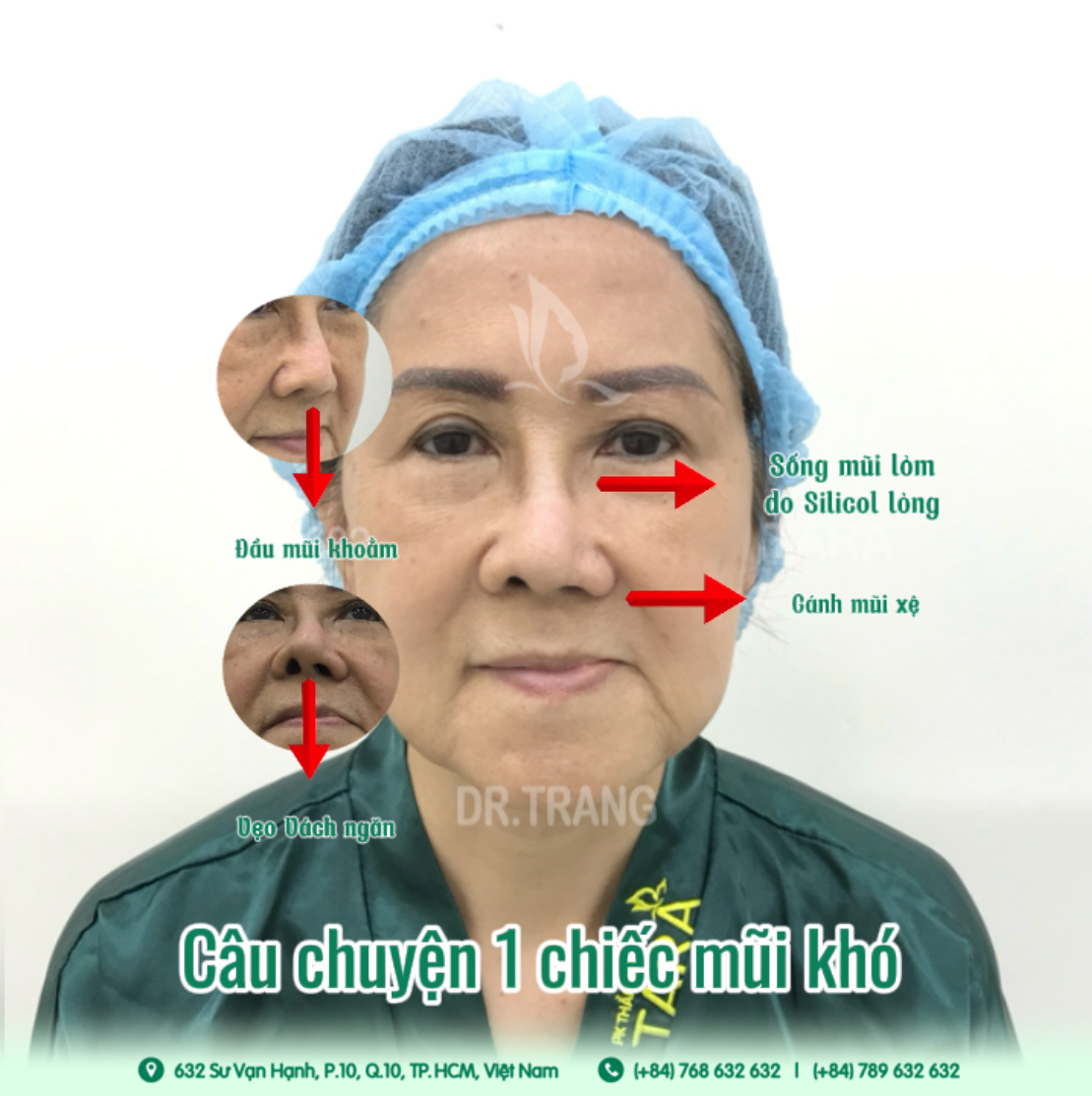 Giá sửa mũi hỏng