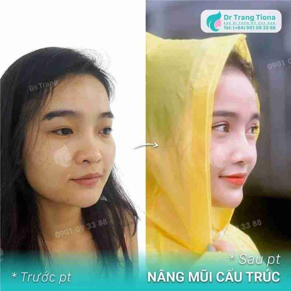 3 điều ít người biết về nâng mũi Sline