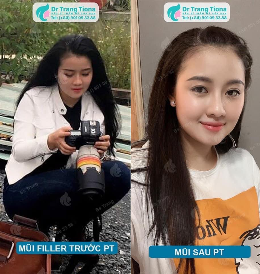 4 biến chứng khi tiêm filler mũi và cách phòng tránh