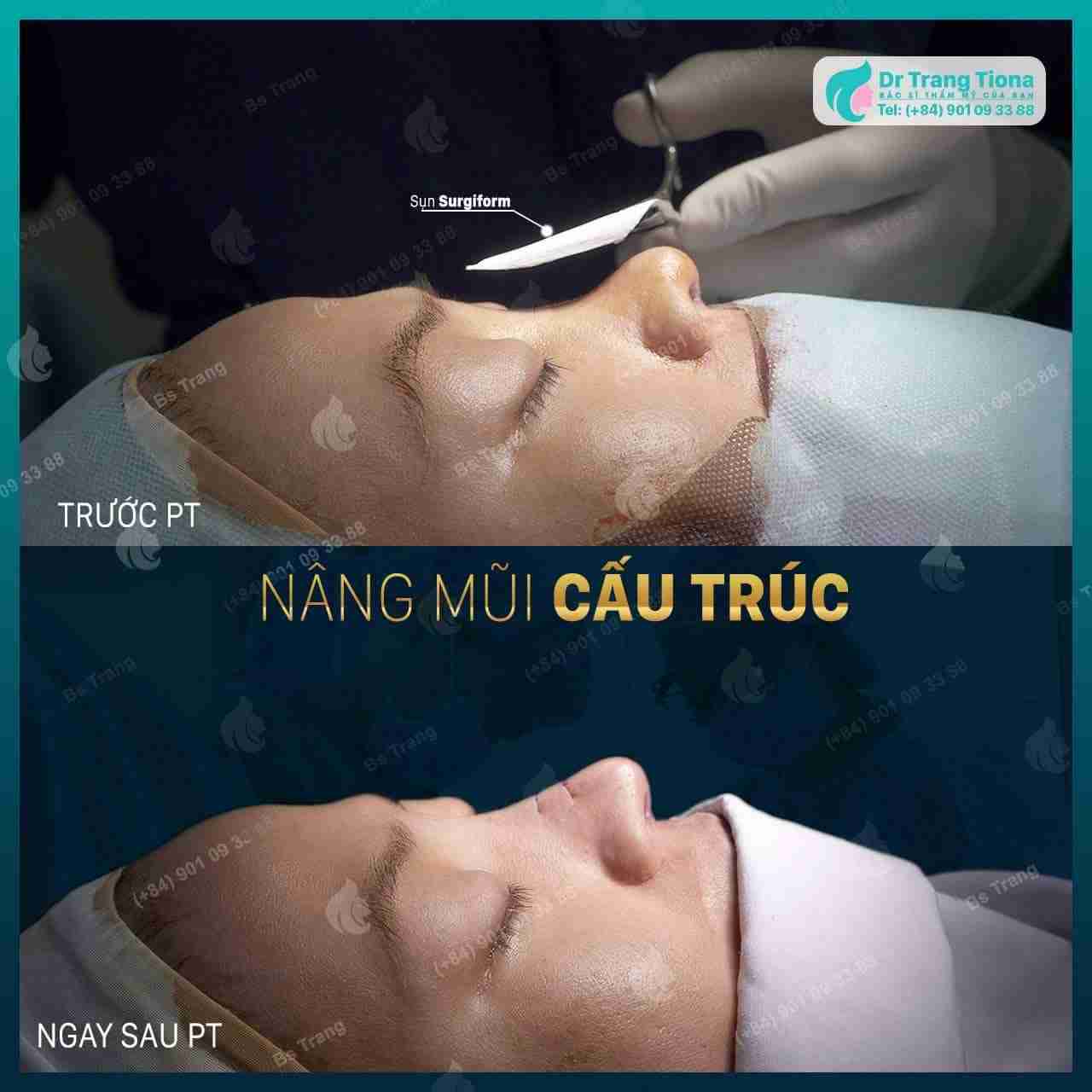 4 lưu ý khi chọn nâng mũi bằng sụn nhân tạo