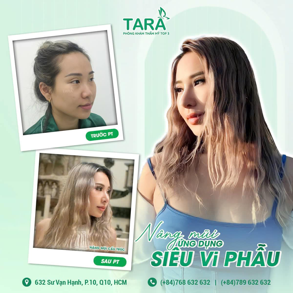5 cái nhất về nâng mũi ứng dụng siêu vi phẫu