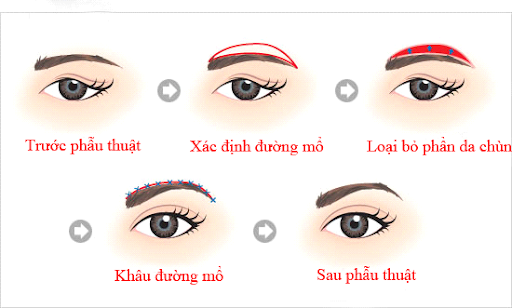 6 biến chứng thường gặp sau khi cắt mí mắt